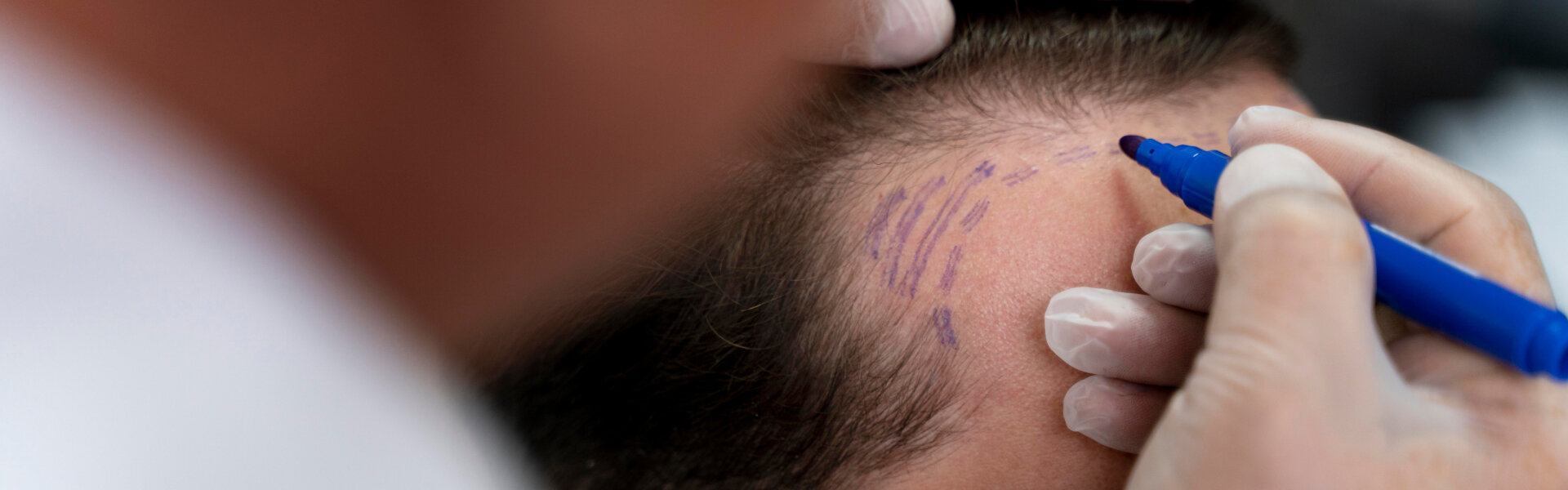 CMG usluge - transplantacija kose, estetska medicina, tretmani za lice i telo