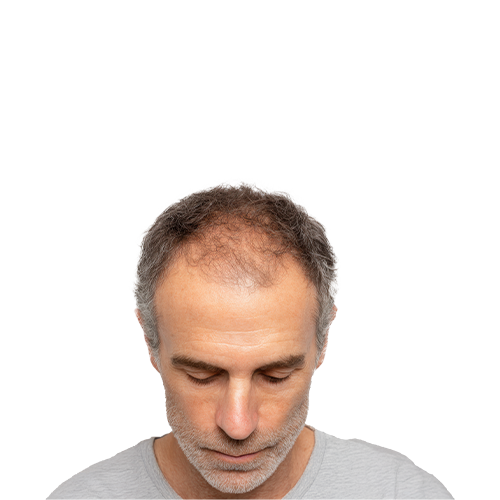Before BIOFIBRE treatment